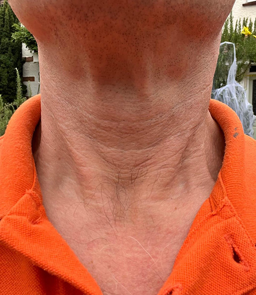 Skin treatment – After