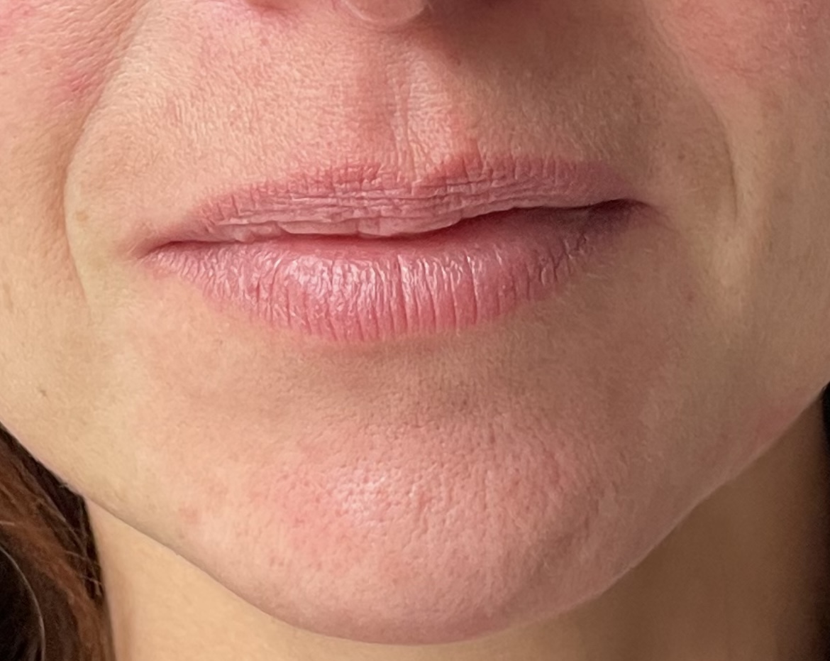 Treatment result
