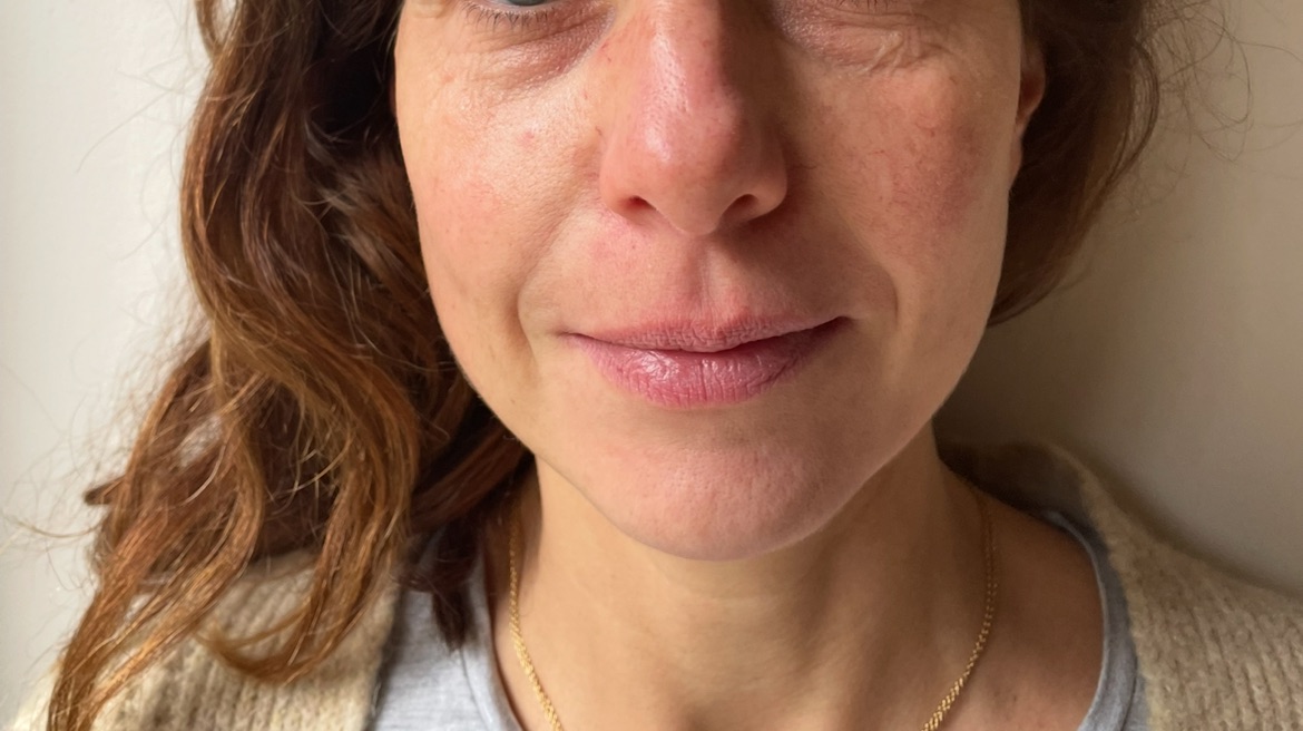 Treatment result