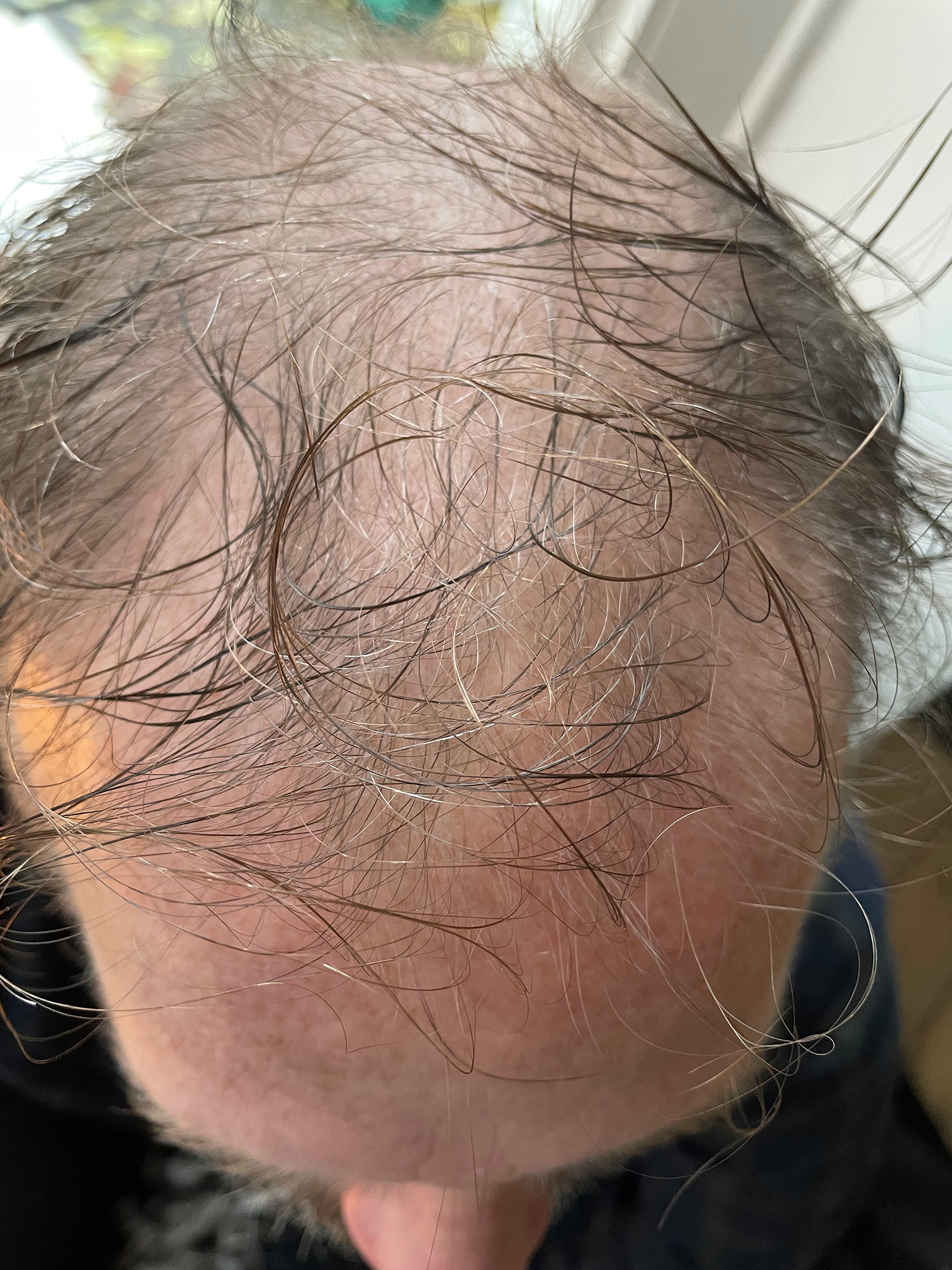 Hair regeneration – Before treatment